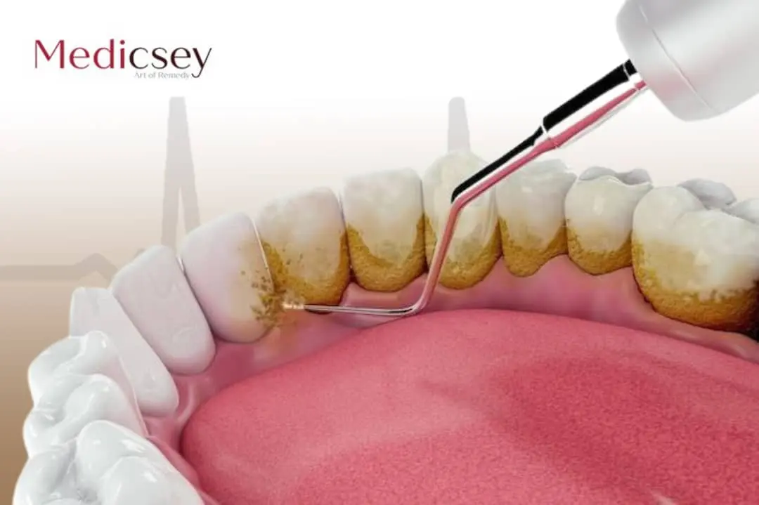 Root canal treatment Turkey 