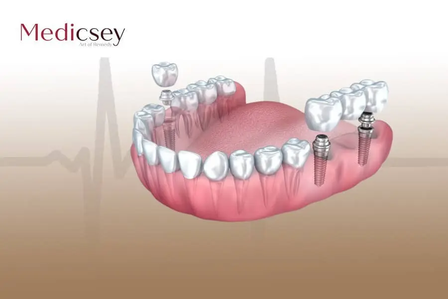  زرعات الأسنان التركية