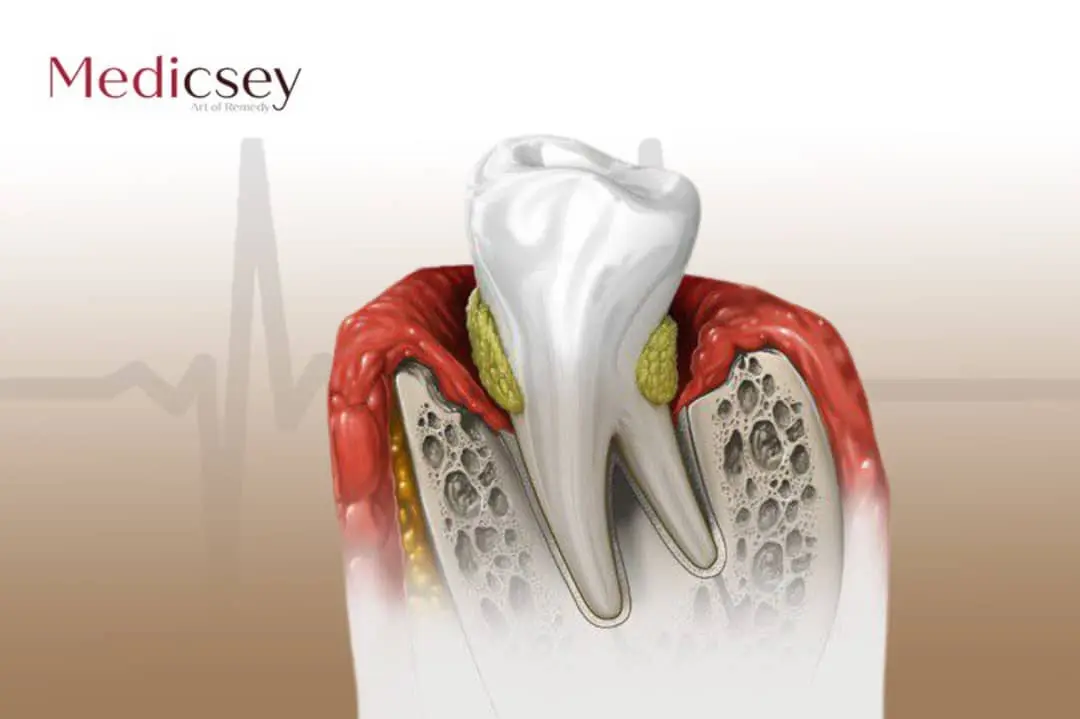 Root canal treatment Turkey 