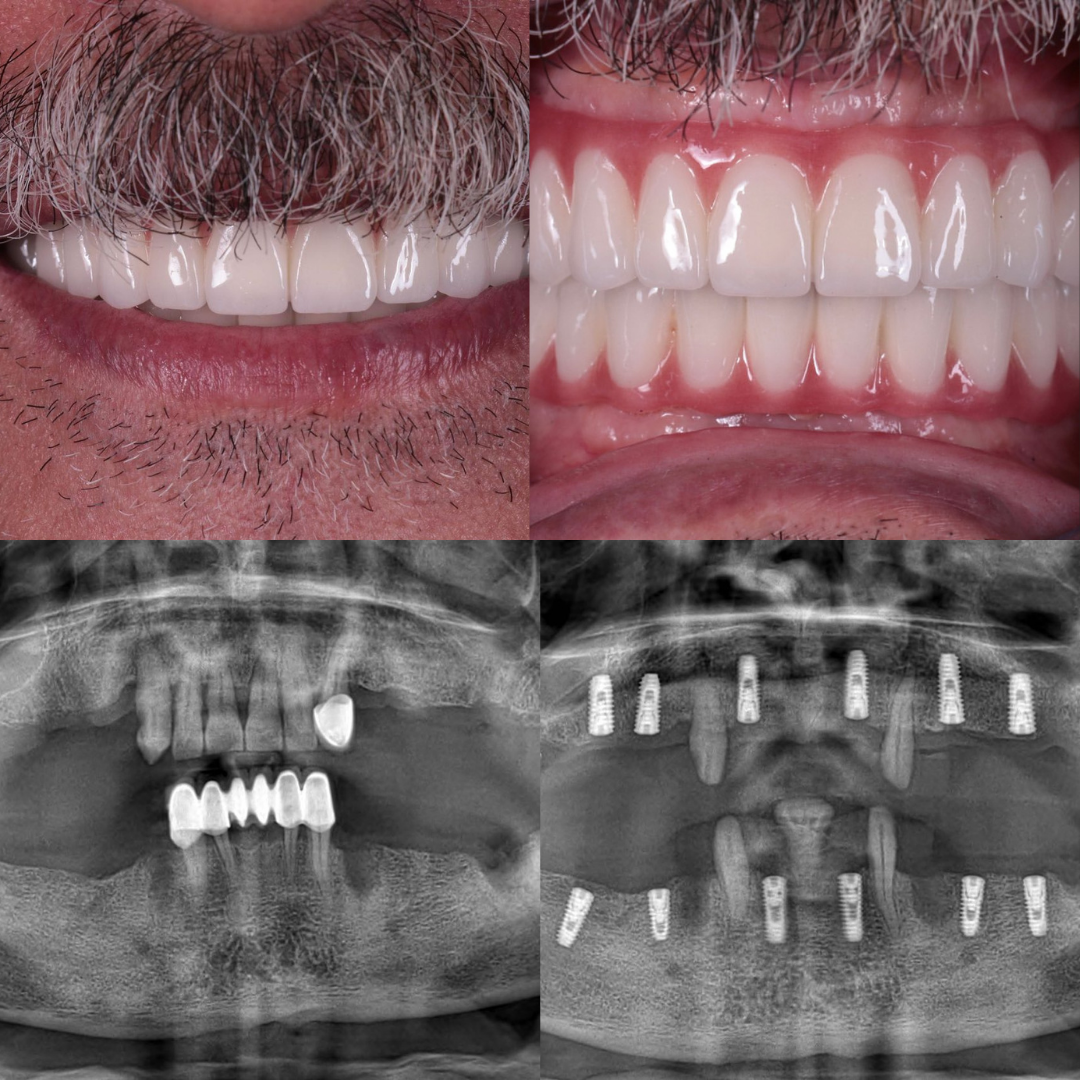 dental implant in turkey