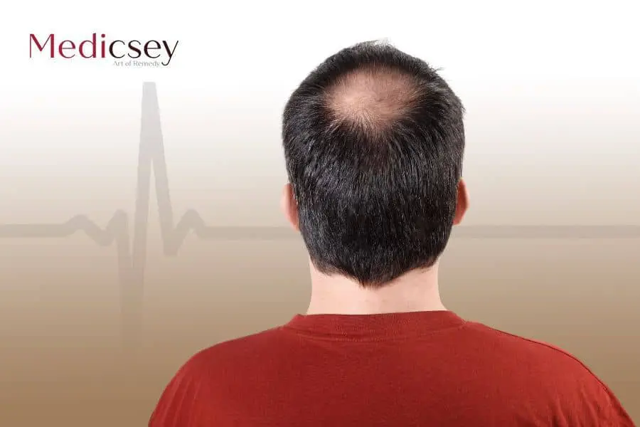 hair loss treatment in Turkey