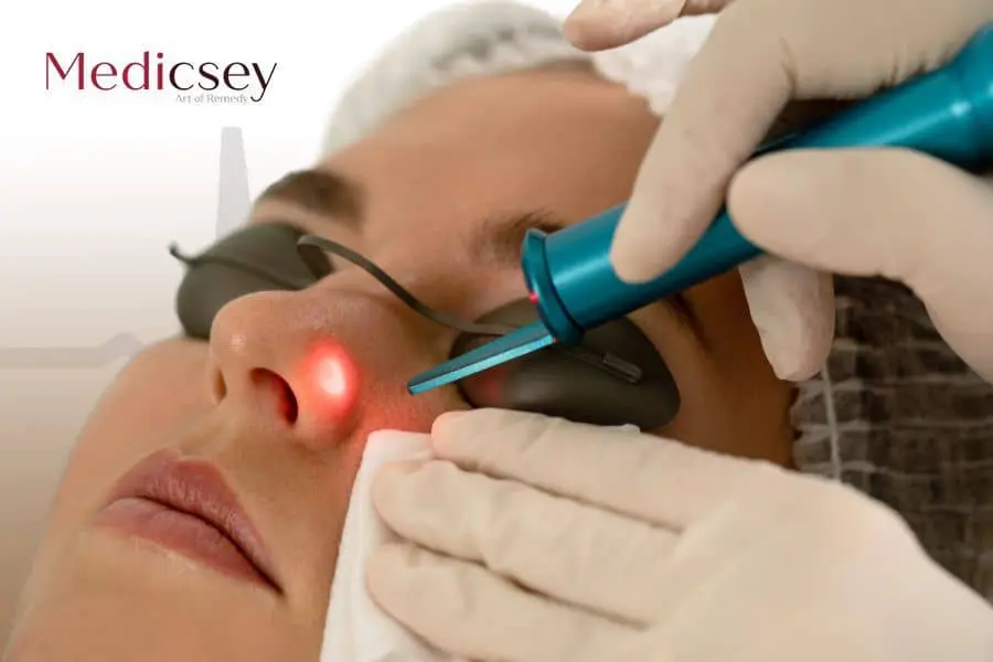 Laser Mole Removal in Istanbul