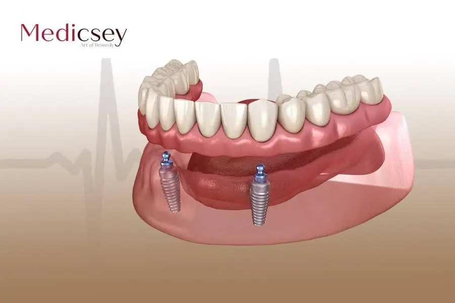 زرعات الأسنان التركية