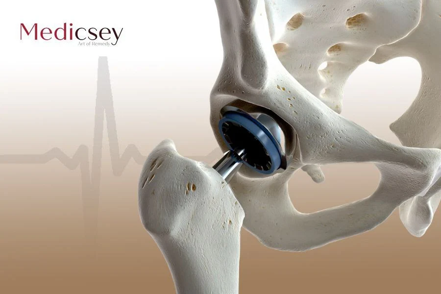 hip replacement surgery in Turkey