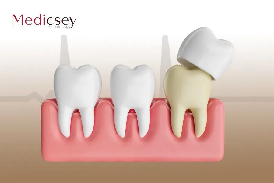 dental crown in Turkey