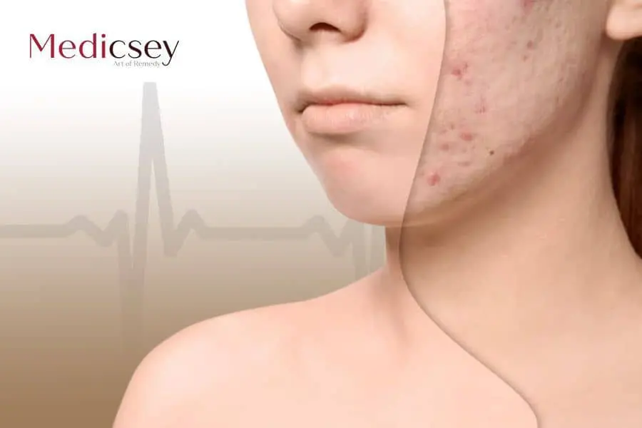 Acne scar treatment in Turkey 