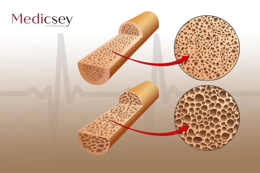 هشاشية العظام في تركيا أسبابها وعلاجها