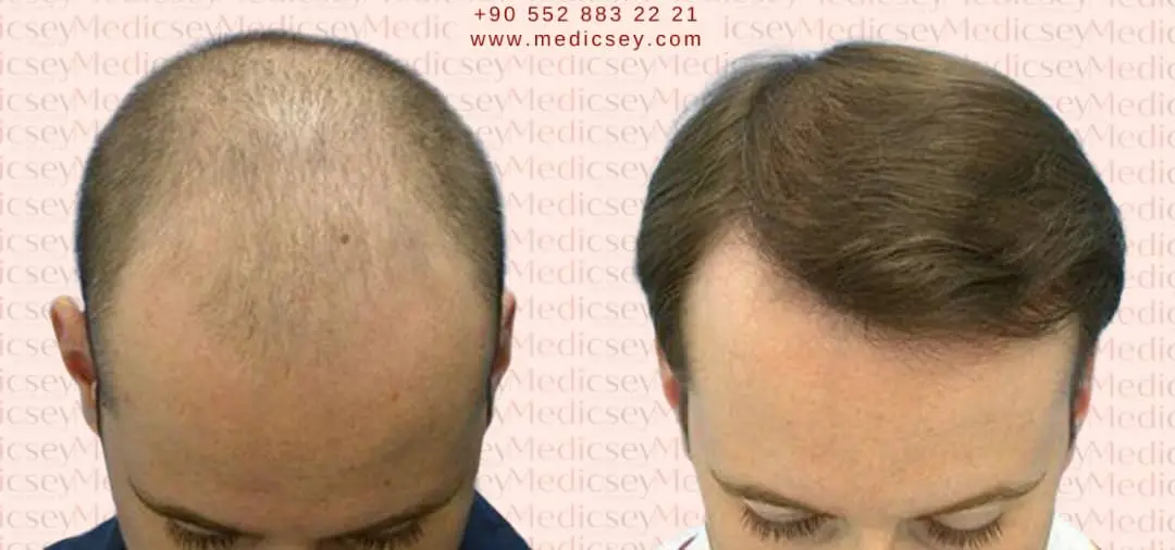 hair transplant in Turkey