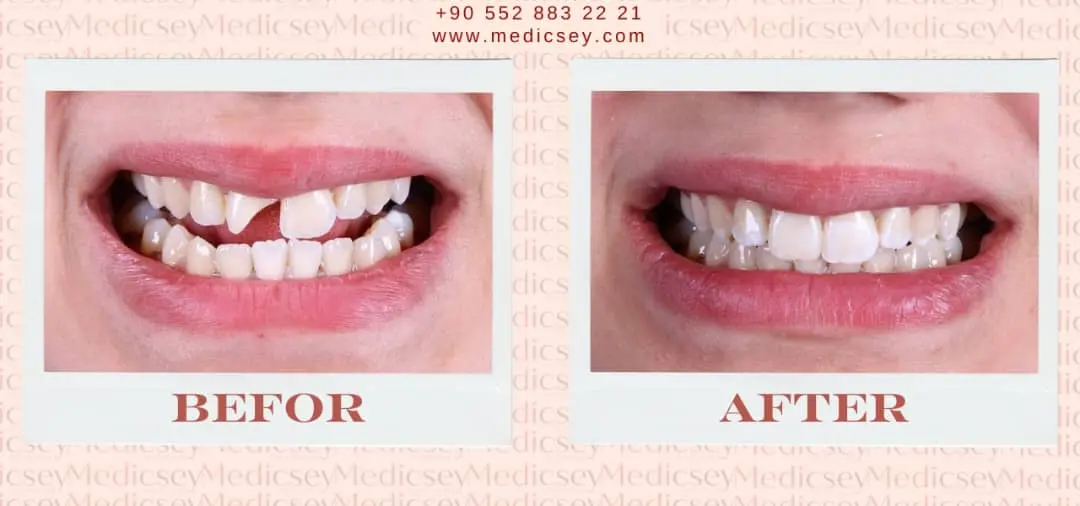  All-inclusive dental packages Turkey