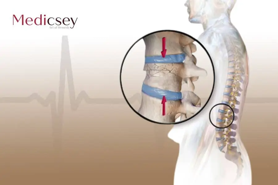 Causes and treatment of herniated disc in Turkey