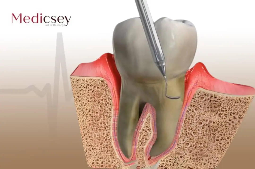 Root canal treatment Turkey 