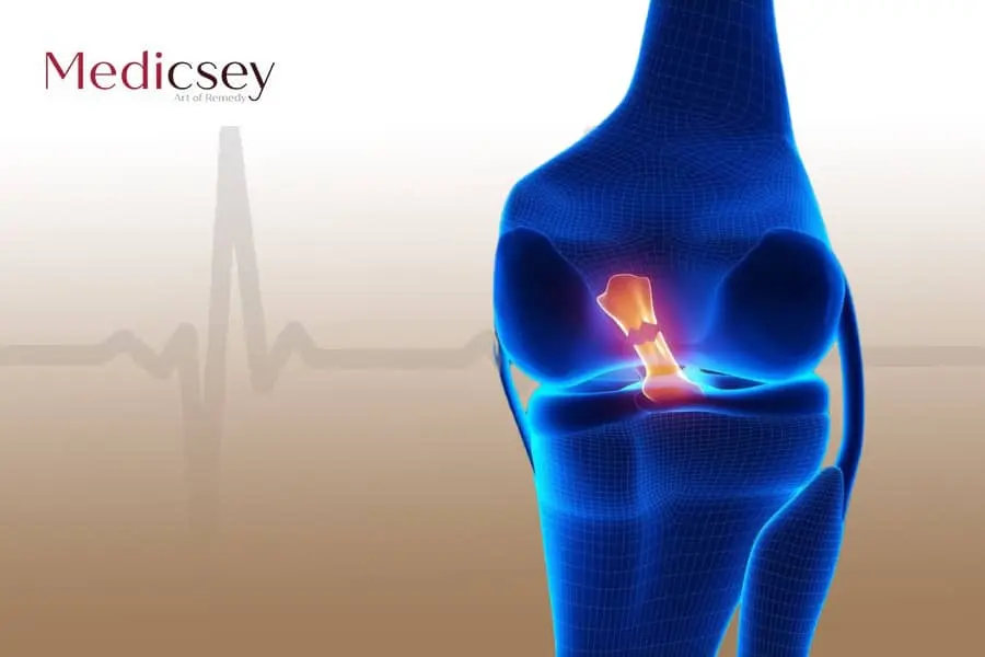 meniscus rupture treatment in Turkey