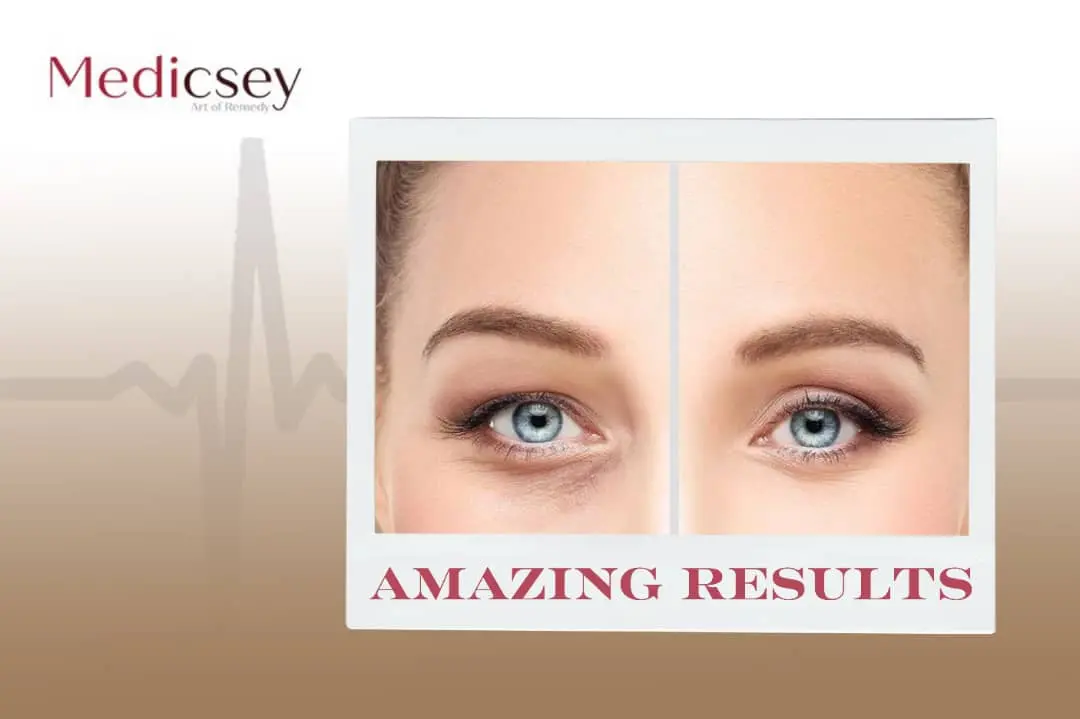 oculoplastic surgery in Turkey