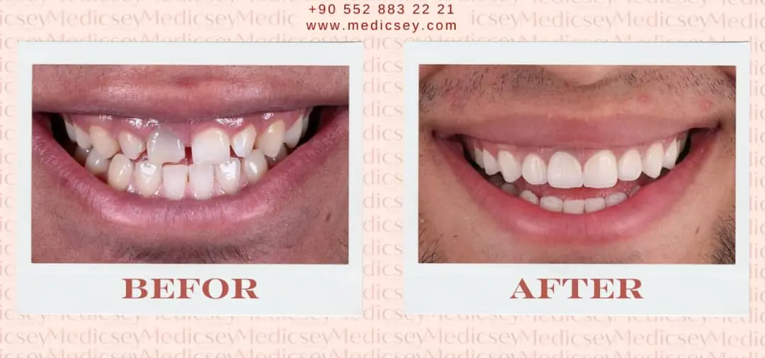  All-inclusive dental packages Turkey