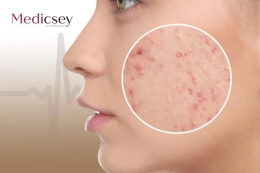 Acne scar treatment in Turkey 