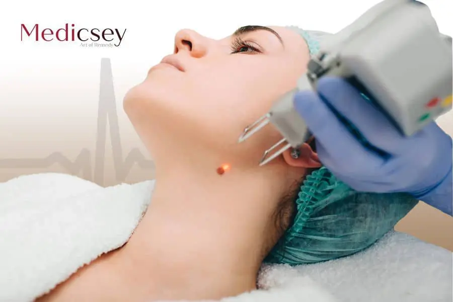 Laser Mole Removal in Istanbul, 