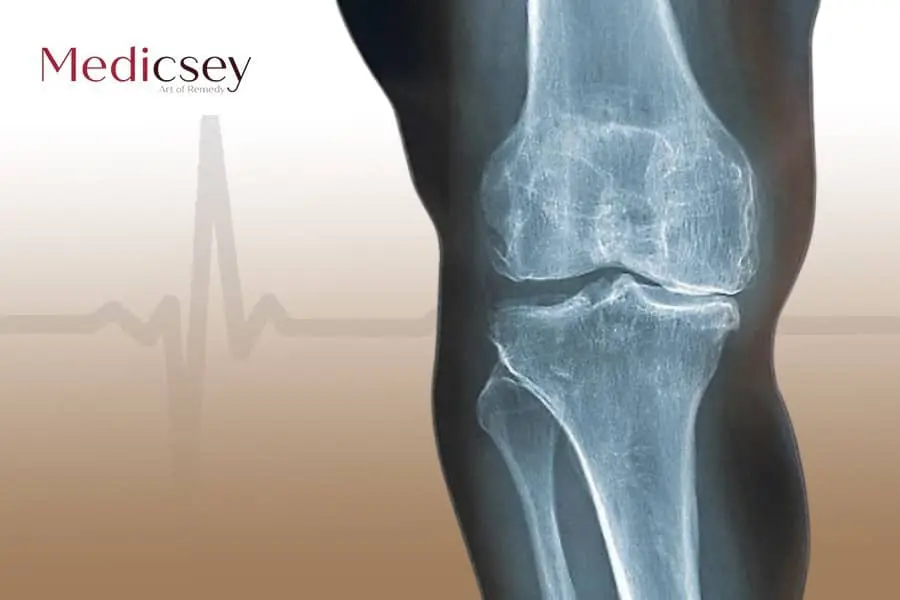 Causes and treatment of osteoarthritis in Turkey