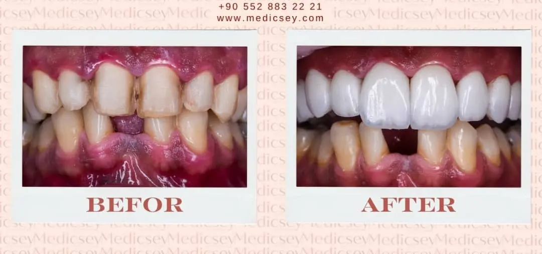 Porcelain Veneers in Turkey