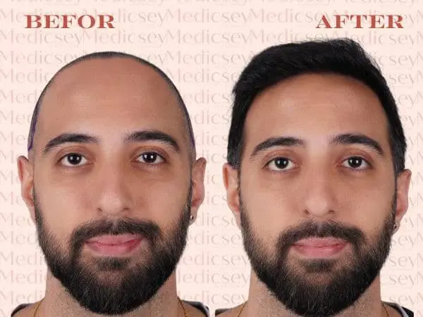 hair transplant in Turkey