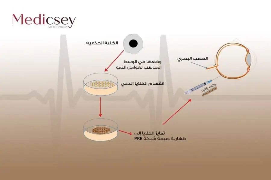 علاج العين بالخلايا الجذعية في تركيا 