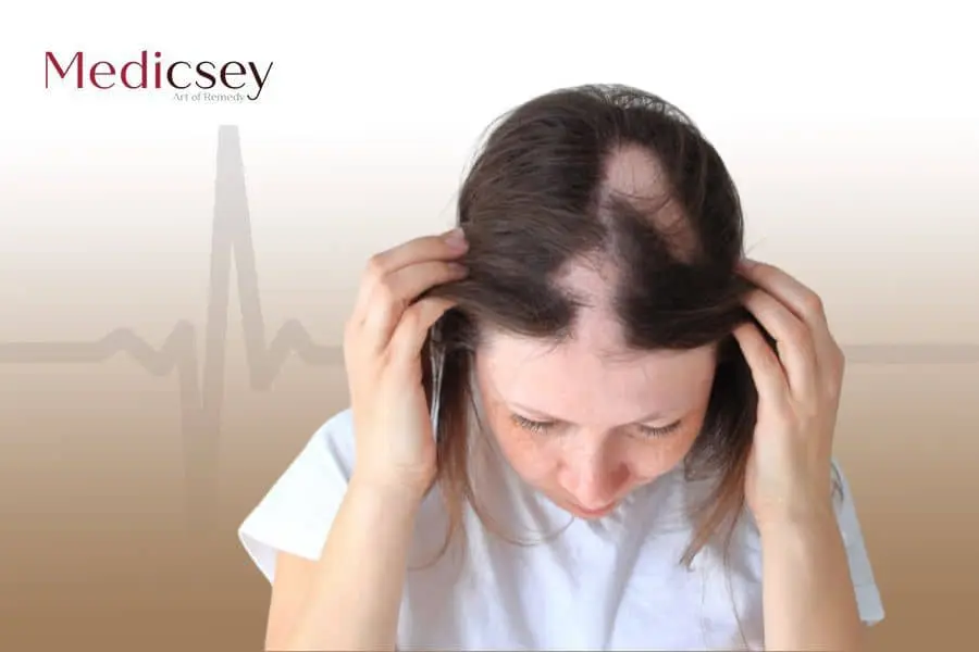 Alopecia treatment in Turkey