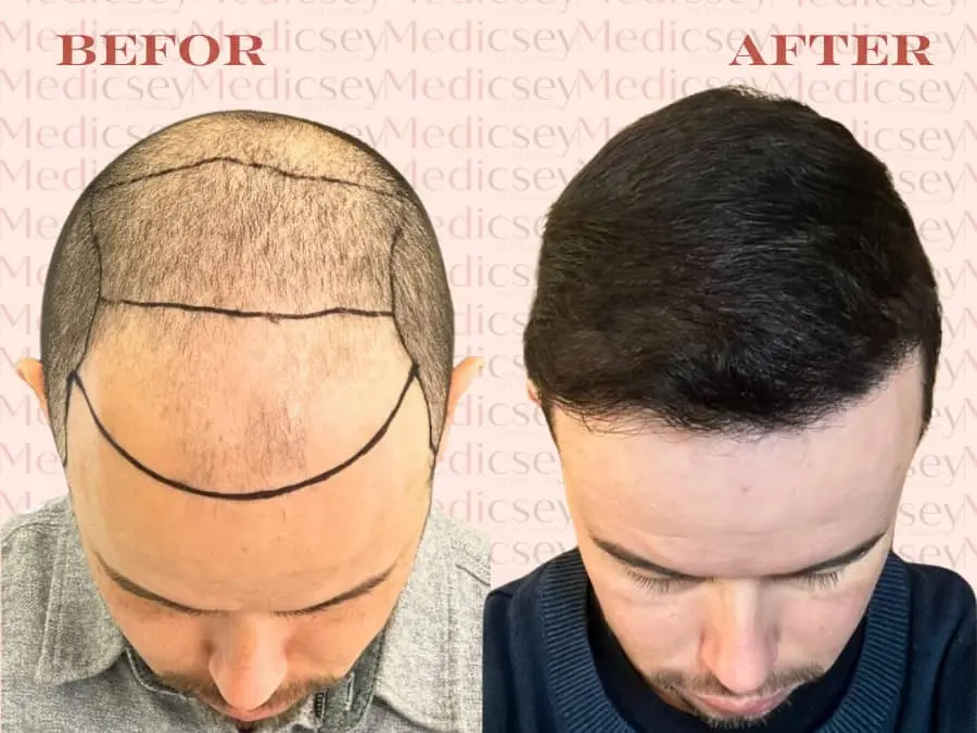 hair transplant in Turkey