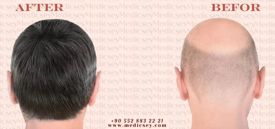 زراعة الشعر في اسطنبول