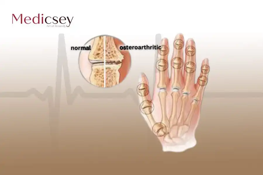 Causes and treatment of osteoarthritis in Turkey