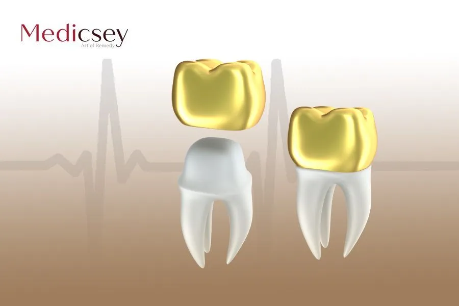 dental crown in Turkey