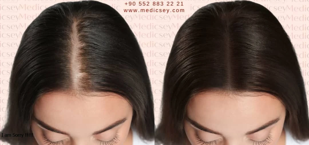 زراعة الشعر في اسطنبول