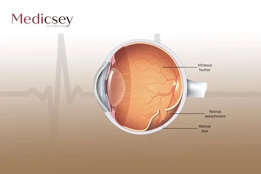 retinal detachment in Turkey 