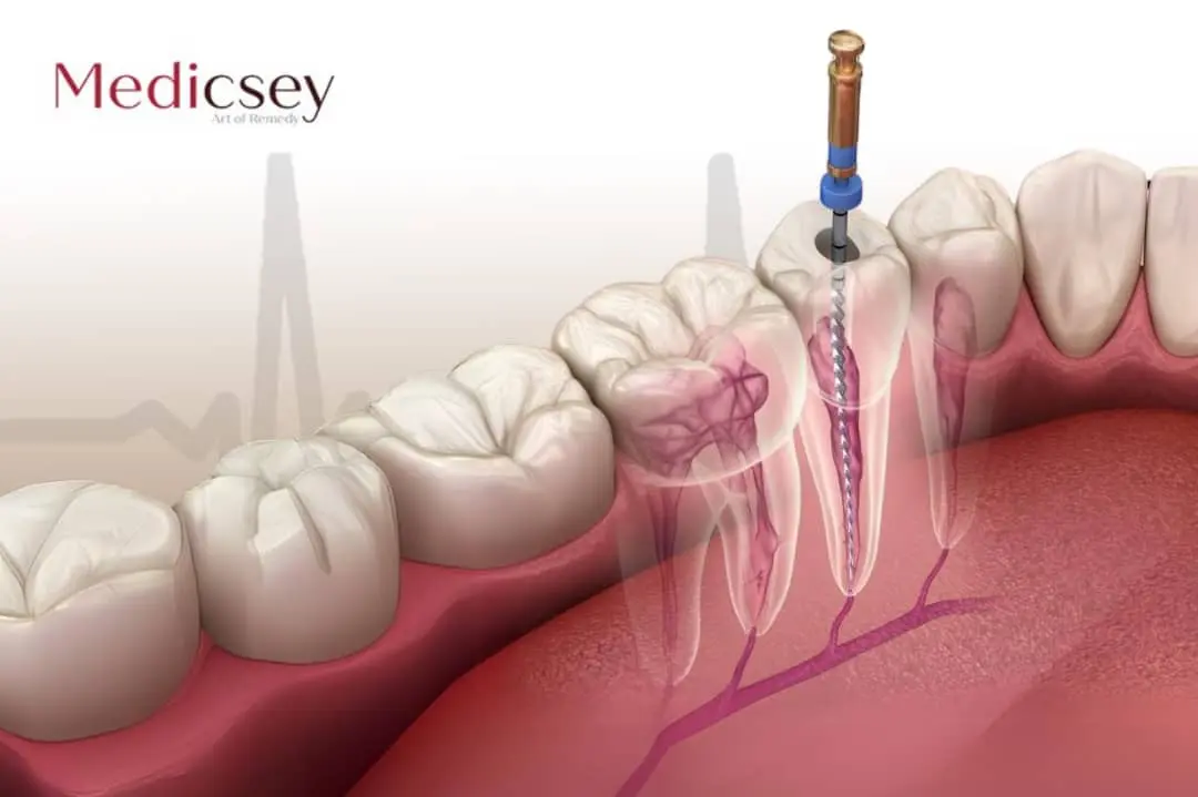 Root canal treatment Turkey 