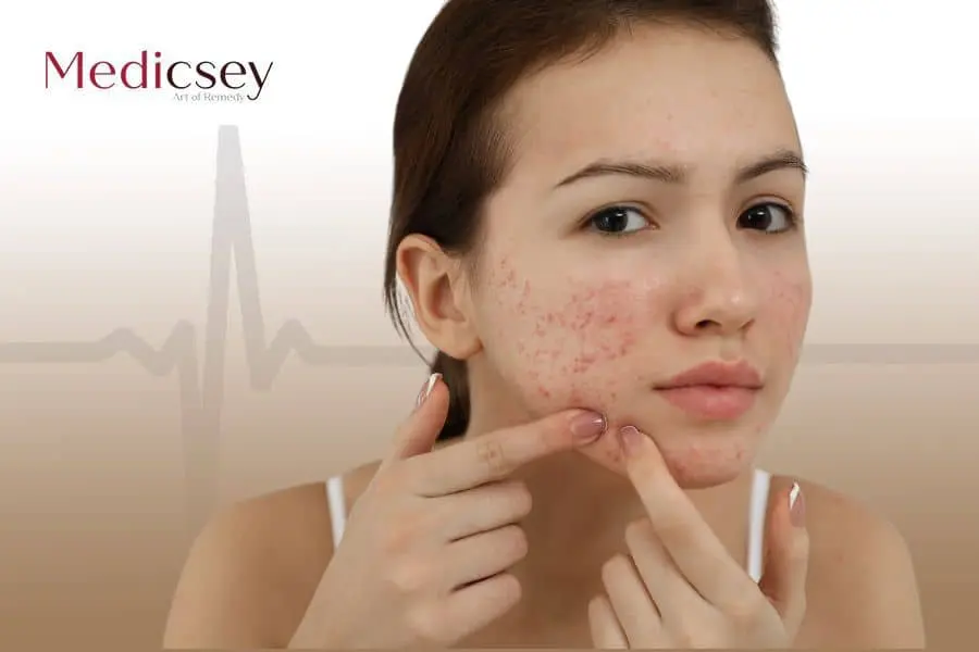 Acne scar treatment in Turkey 