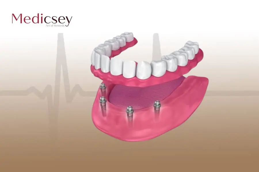 زرعات الأسنان التركية