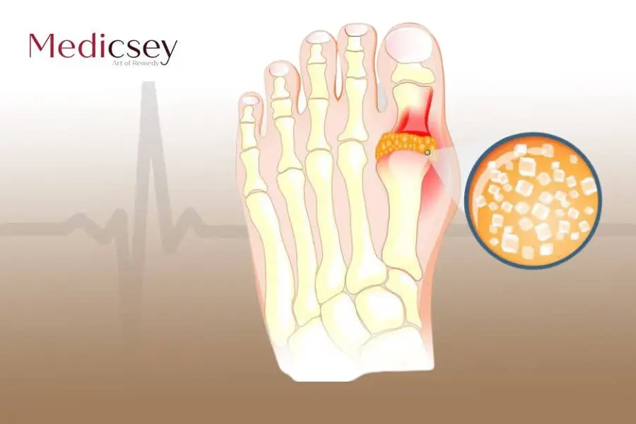 Causes and treatment of gout in Turkey