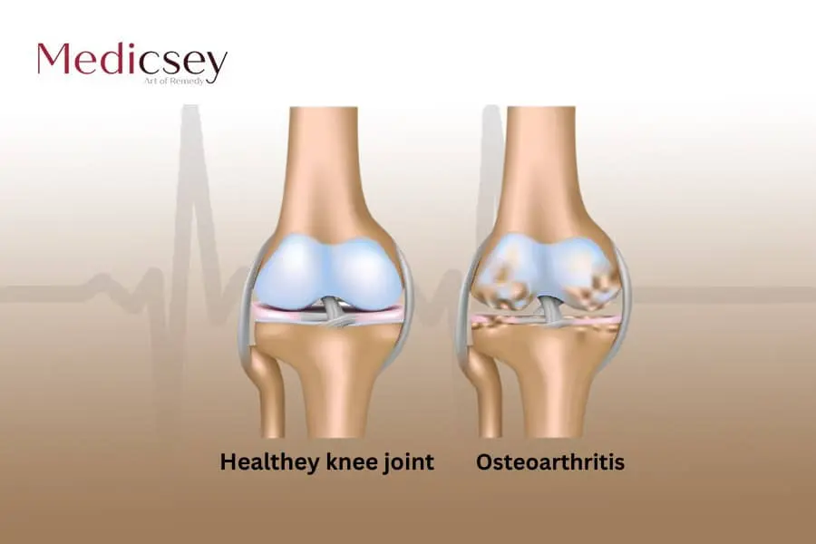 Causes and treatment of osteoarthritis in Turkey