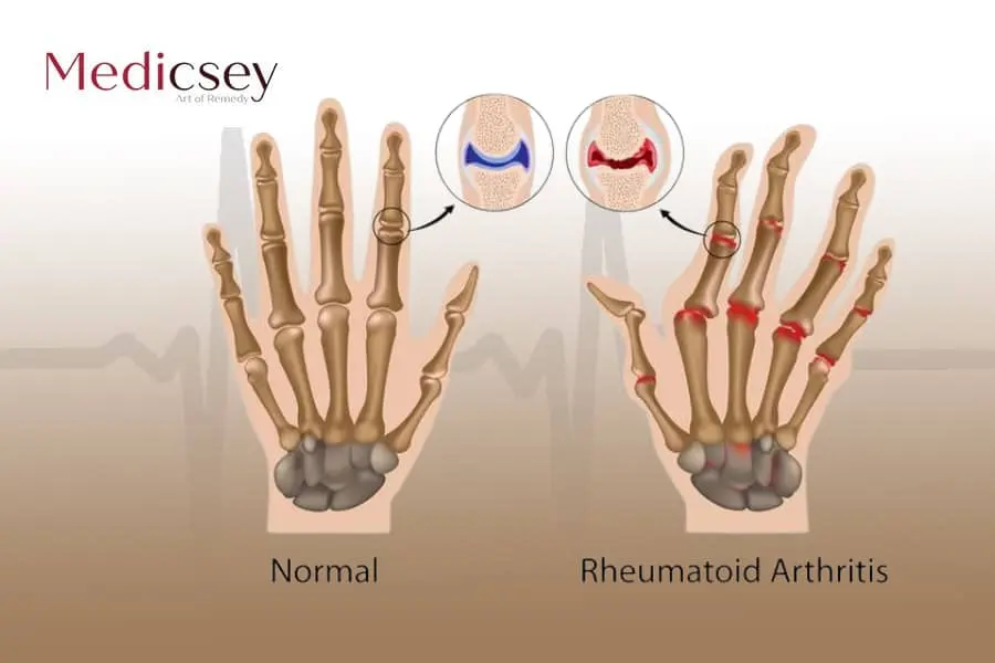 Causes and treatment of rheumatoid arthritis in Turkey