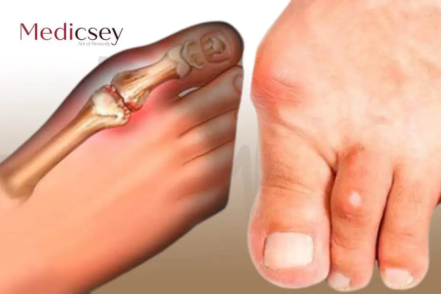 Causes and treatment of gout in Turkey