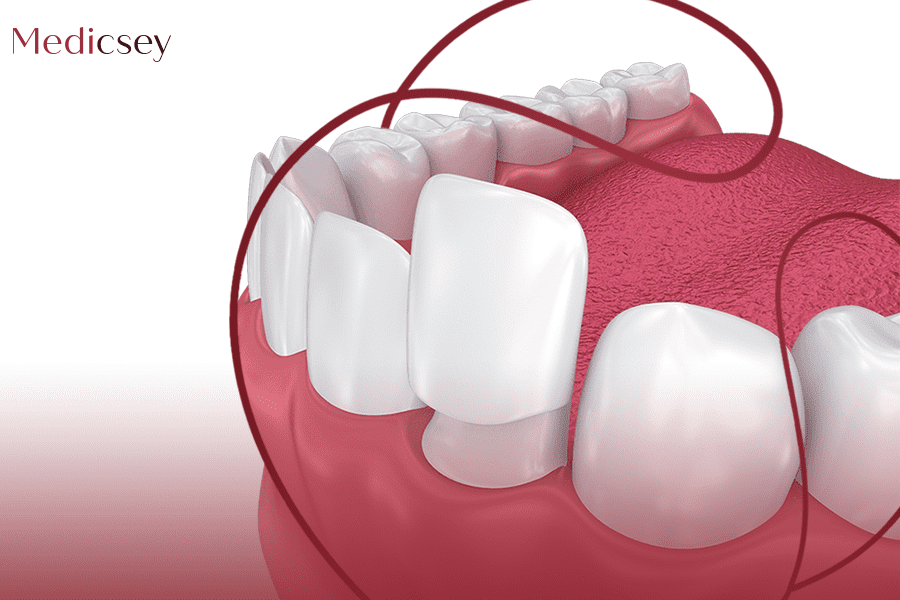 Dental Veneers in Turkey Prices