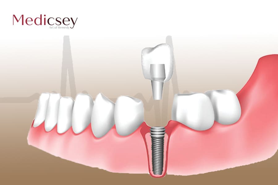 Dental implant prices in Turkey