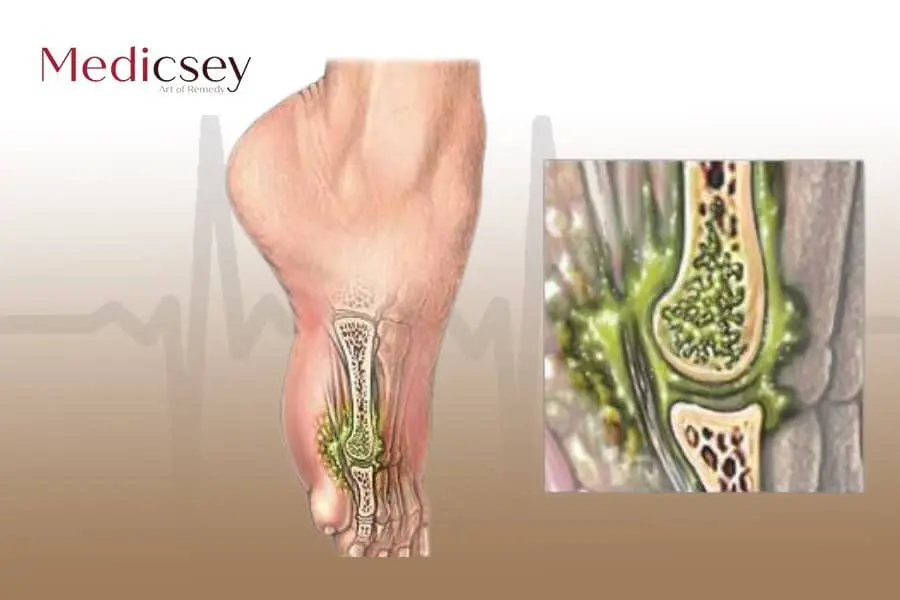 Osteomyelitis in Turkey, its causes and treatment