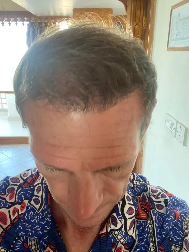Hair Transplant