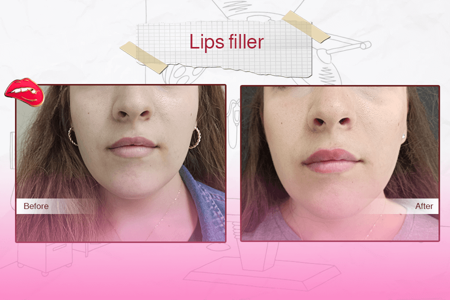 Lip Filler