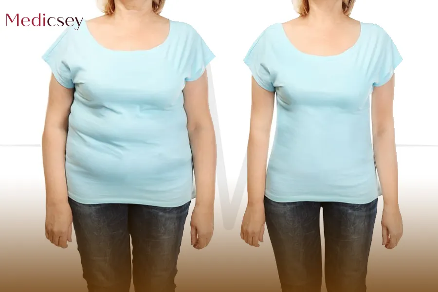 Gastric Sleeve