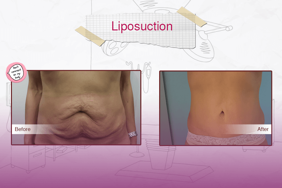 Liposuction