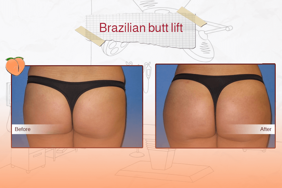 Brazilian Butt Lift