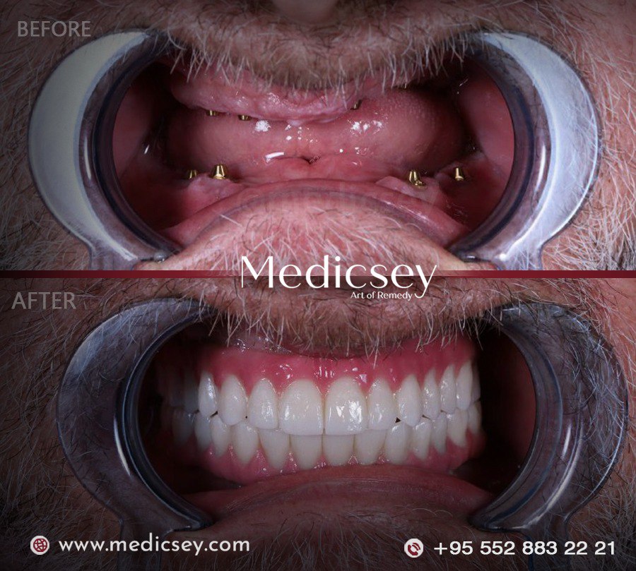 Dental İmplant