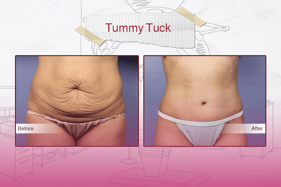 Tummy Tuck