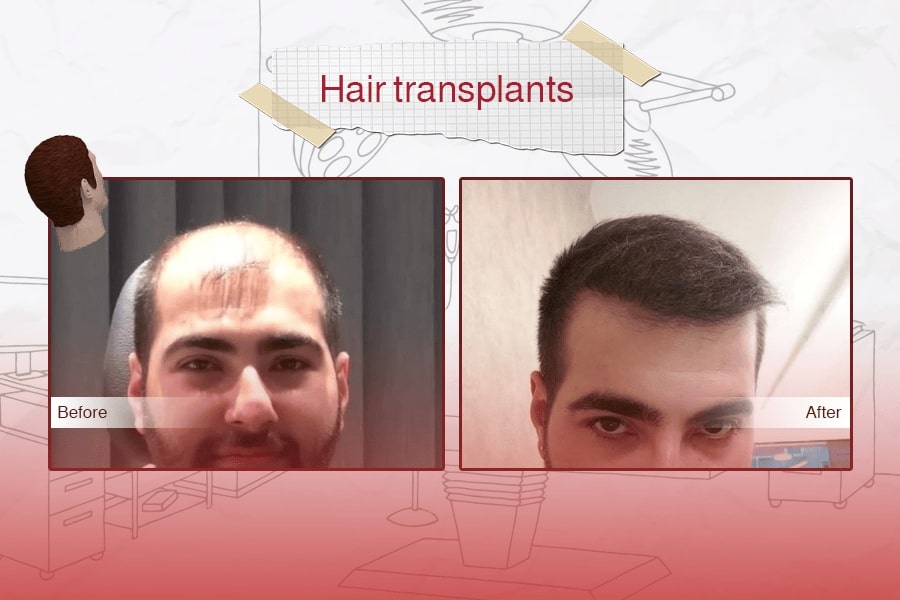 Hair Transplant