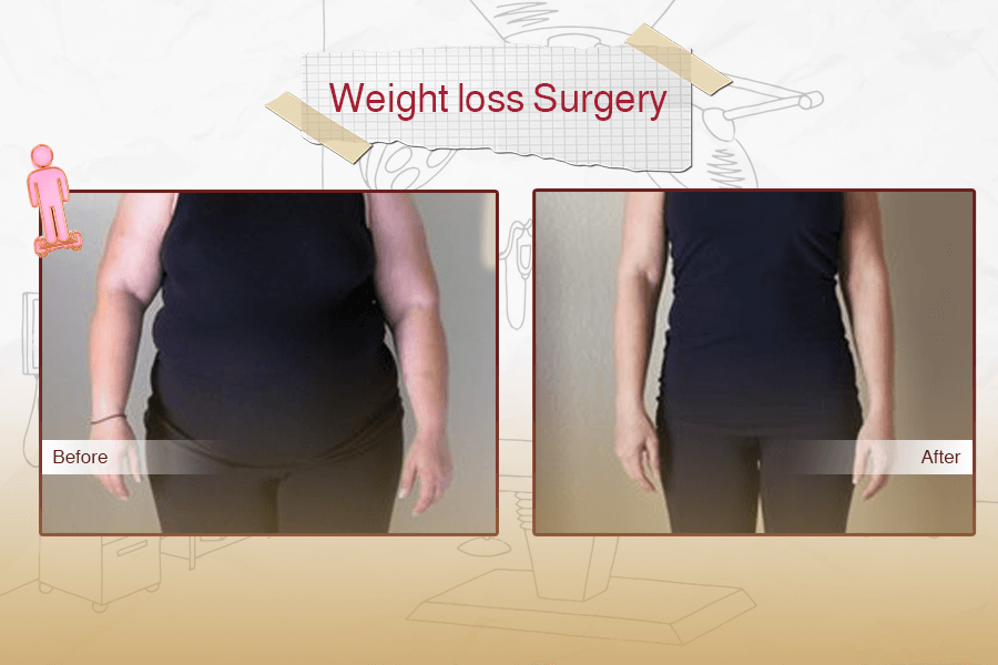 Weight Loss Surgery